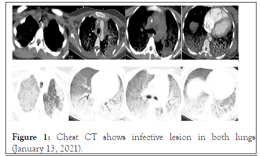ancient-diseases-Chest CT